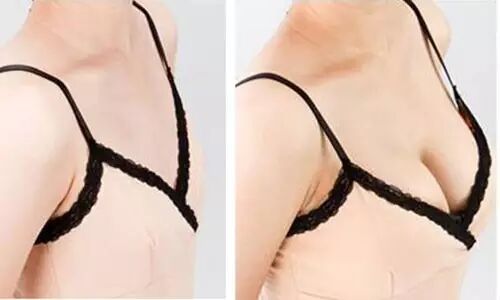 胸部无痕隆乳术——超完美的隆胸方法插图1