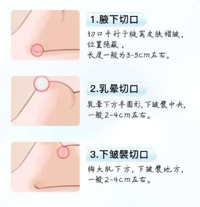 金华隆胸医生前十名!医生技术精|人气高详细详情!插图4 金华隆胸医生前十名!医生技术精|人气高详细详情!插图4