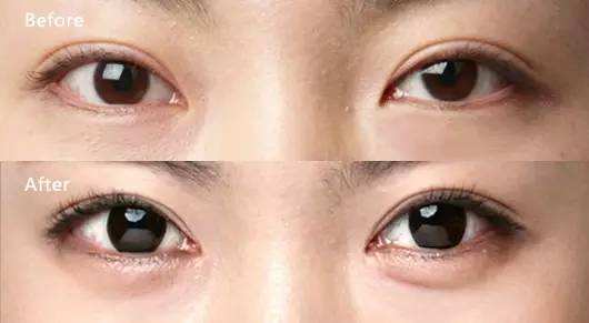 哪些人不适合注射卧蚕？注射丰卧蚕后注意事项！插图