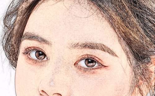湘雅医院眼袋切除手术术后120天案例分析插图2