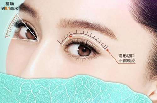 济宁刘郭割双眼皮怎么样？价格合理、自然派代表、术后效果满意插图2