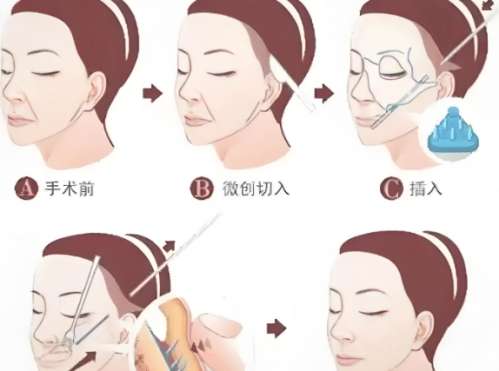 董志勇医生做筋膜提升好不好?医生专业技术水平信息!插图1 董志勇医生做筋膜提升好不好?医生专业技术水平信息!插图1