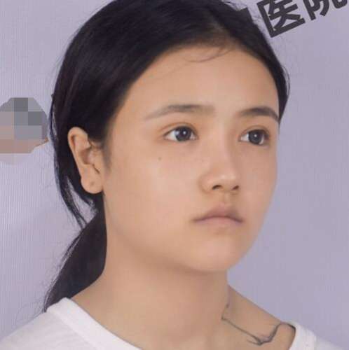 张柱允磨骨案例分析插图1 张柱允磨骨案例分析插图1