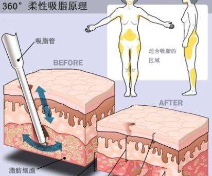 郭昌灏吸脂口碑怎么样？多少钱？收费价格参考&个人资料展示插图1