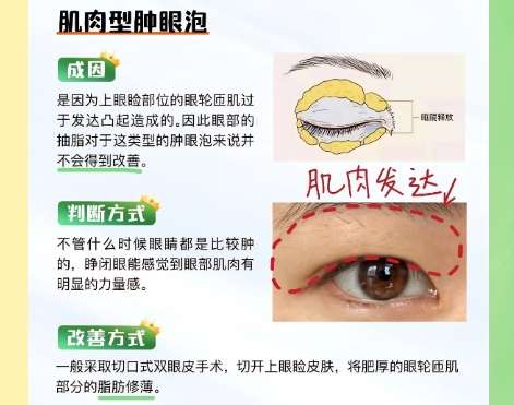 宁波双眼皮医生排名!医生技术把握程度相当娴熟!插图4 宁波双眼皮医生排名!医生技术把握程度相当娴熟!插图4