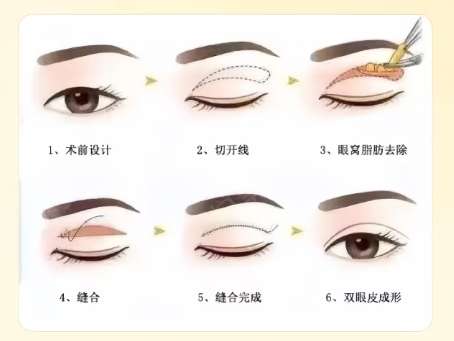 保定双眼皮修复好的公立医生有哪些？医生资料分享！点击收藏插图4