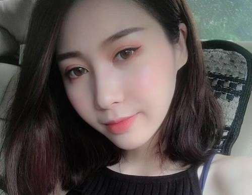 尹伟力医生双眼皮修复案例分析插图4 尹伟力医生双眼皮修复案例分析插图4
