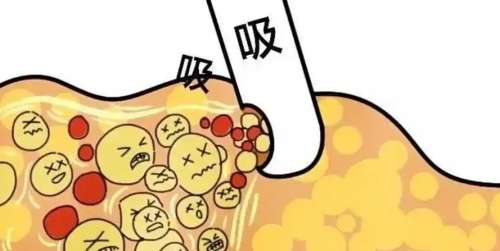 王荣锡医生吸脂怎么样?医生口碑评价来袭!就诊必看插图1 王荣锡医生吸脂怎么样?医生口碑评价来袭!就诊必看插图1