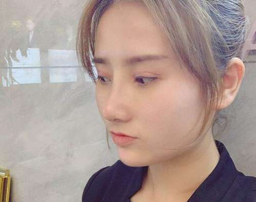 郝冬月医生做的双眼皮案例分析插图2 郝冬月医生做的双眼皮案例分析插图2