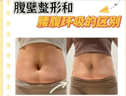 北京艺星韩院长吸脂技术怎么样?真实经历案例分享插图4 北京艺星韩院长吸脂技术怎么样?真实经历案例分享插图4