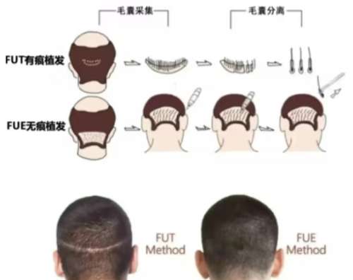 胡志奇植发多少钱?做的好吗?附客户真实点评插图4 胡志奇植发多少钱?做的好吗?附客户真实点评插图4