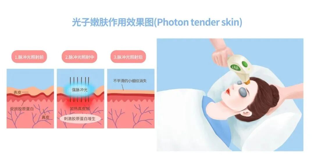长沙超光子嫩肤多少钱一次？哪家医院好插图1
