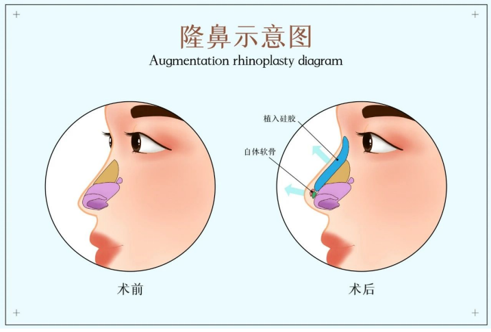 鼻部整形手术疼吗?做完鼻部手术手术后忌七点能快速消肿插图1 鼻部整形手术疼吗?做完鼻部手术手术后忌七点能快速消肿插图1