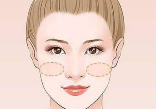 蹇洪苹果肌复位多少钱?插图1 蹇洪苹果肌复位多少钱?插图1