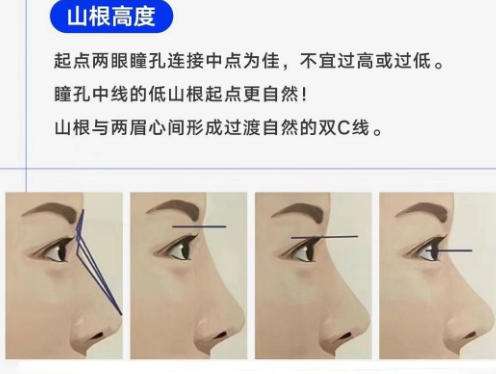 田雅光双眼皮属于什么档次？实力典评技术优势术后案例一览插图2