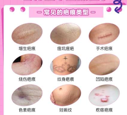 吕开阳医生最厉害三个方面公布！祛疤、吸脂等技术剖析！插图4