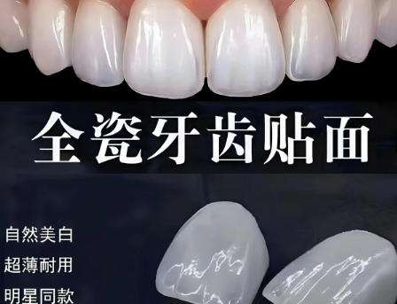 深圳华诚齿科贴面多少钱?医院热门项目收费明细分析!插图1 深圳华诚齿科贴面多少钱?医院热门项目收费明细分析!插图1