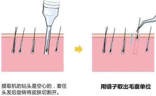 八大处整形医院张波植发术后120天案例|技术评价怎么样?价格明细插图1
