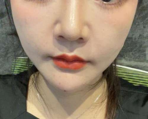 陈小平鼻基底案例，精致美鼻轻松打造插图3
