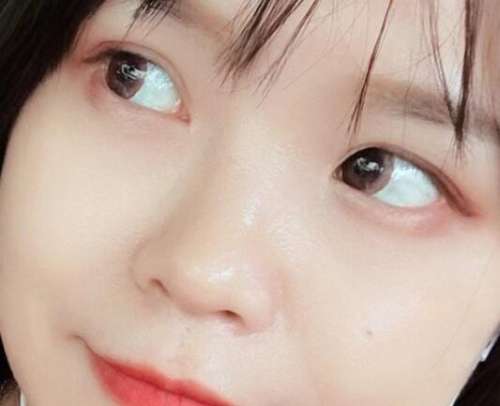 黄威双眼皮案例，术后形态和弧度都是好的插图2