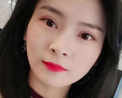 王琪影双眼皮案例，轻松打造明眸大眼插图2