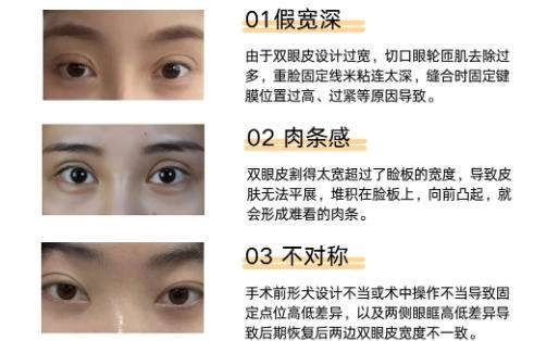 李天石双眼皮修复案例详解来袭！速速来看插图1