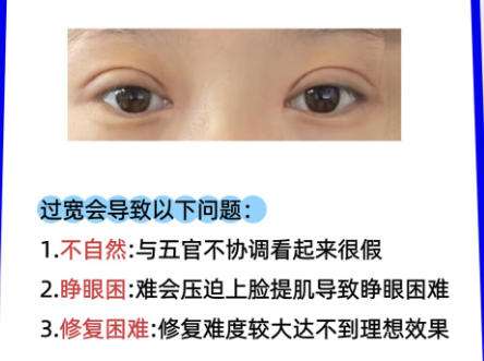 李天石双眼皮修复案例详解来袭！速速来看插图2