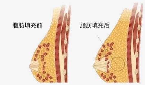 合肥脂肪隆胸专家名单汇总！陈增红、朱飞上榜！含医生信息插图4