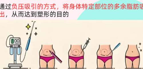唐都医院李跃军医生出诊时间查询！吸脂技术口碑好！案例解析插图4