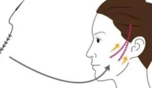 南京轮廓固定价格贵不贵？南京哪几家医院技术好呢?插图1