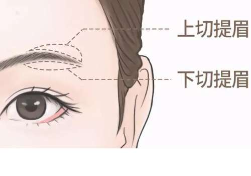 海淀医院提眉多少钱？手术费用6000元起，预算党友好，普通人消费得起插图