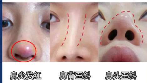 武凤莲做双眼皮怎么样好看吗？医生简介双眼皮案例精选插图4