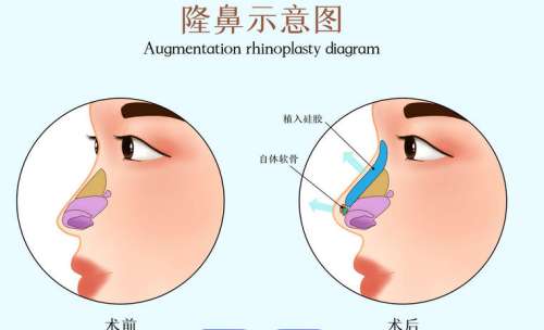 上海九院俞哲元怎么样？资质/技术/价格全曝光！双眼皮技术好插图2