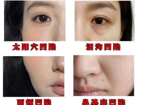 谭骛远医生脂肪微雕怎么样？收费表公布！费用低至2万5左右插图2