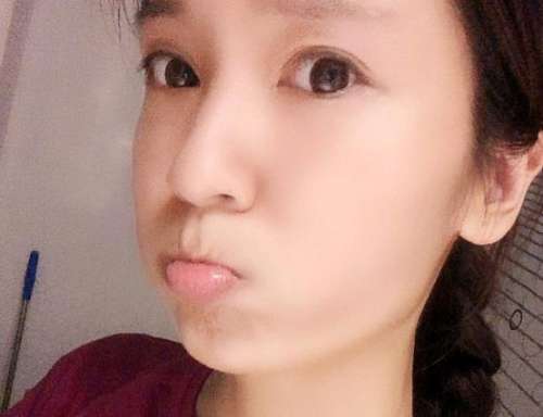李发成自体脂肪案例,一举两得,丰面又瘦腰插图4 李发成自体脂肪案例,一举两得,丰面又瘦腰插图4