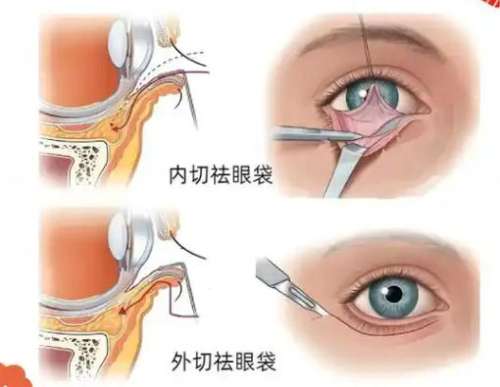 马晓荣医生的口碑怎么样？双眼皮、去眼袋技术点评！插图1