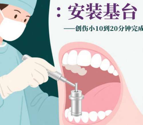 无锡种牙价格一般多少?价格表公示_含推荐医院插图4 无锡种牙价格一般多少?价格表公示_含推荐医院插图4