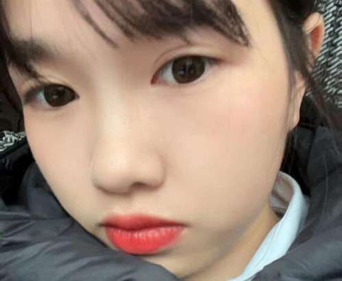 吉大一院董雪双眼皮案例，打造精致美眼如此简单插图3
