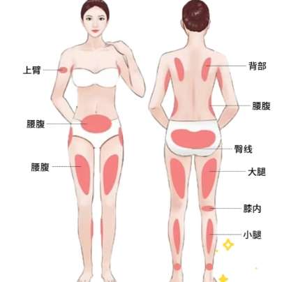 浙一医院徐靖宏吸脂怎么样？腰部吸脂3万4起！附经典案例插图3