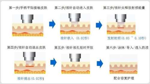 深圳黄金微针多少钱做一次?富华\非凡\米兰柏羽等,价格3千-8千元不等插图 深圳黄金微针多少钱做一次?富华\非凡\米兰柏羽等,价格3千-8千元不等插图