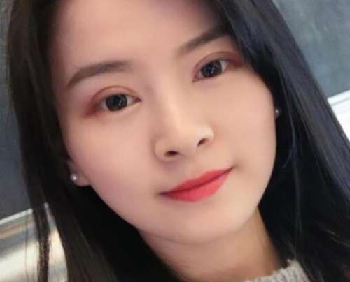 王琪影双眼皮案例，轻松打造明眸大眼插图1