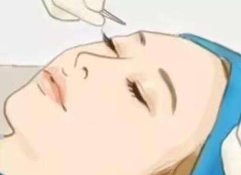 吴焱秋教授修复内眼角厉害吗？医生技术一绝！风格审美完全在线！插图1