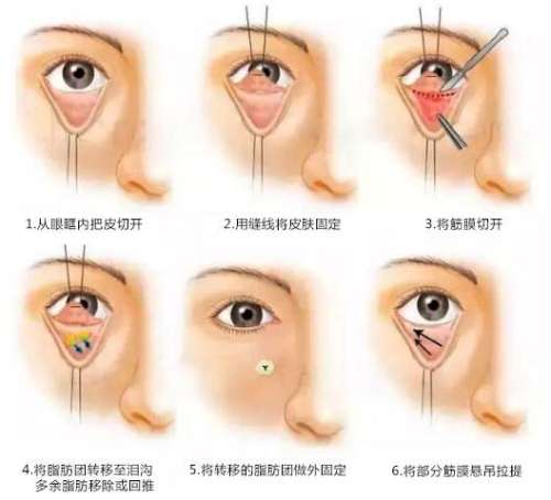 长春铭医做眼袋多少钱?激光3千元起\内切4千起\综合抗衰1.2万元起插图 长春铭医做眼袋多少钱?激光3千元起\内切4千起\综合抗衰1.2万元起插图
