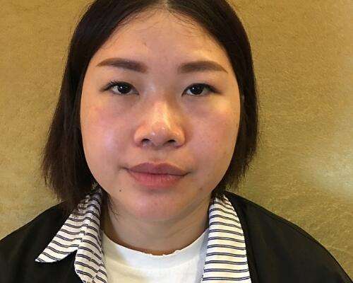高海鹰医生双眼皮案例，塑造看得见的美丽插图1