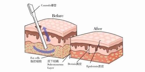 张怀军医生抽脂多少钱？参考价格6000元起，带技术点评+执业机构插图2