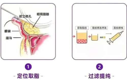 上海去眼袋手术价格 ,2026最新参考,避免隐形消费插图1 上海去眼袋手术价格 ,2026最新参考,避免隐形消费插图1