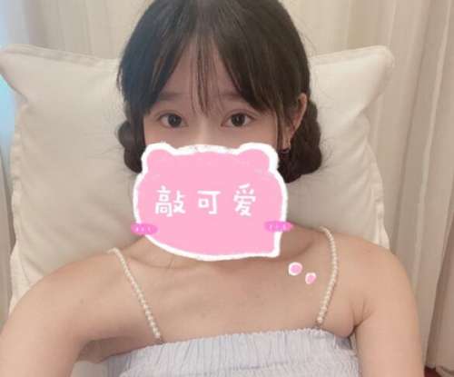 陈贵宗双眼皮案例，让美从窗户开始插图3
