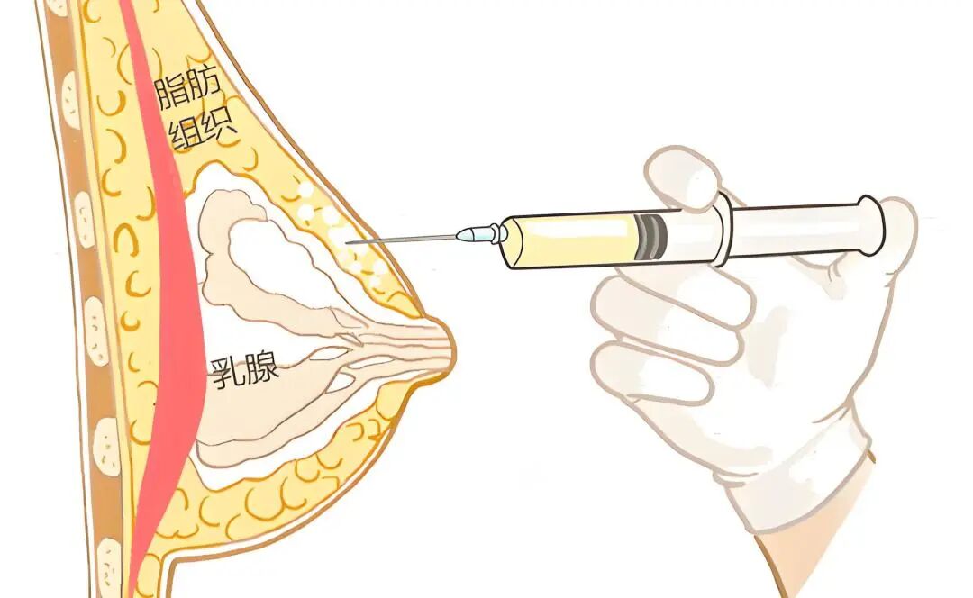 杭州丰胸哪家整形医院好?自体脂肪移植丰胸误区插图2 杭州丰胸哪家整形医院好?自体脂肪移植丰胸误区插图2