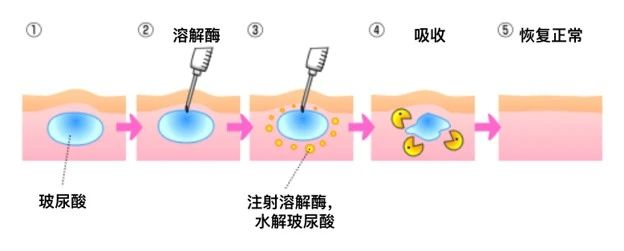 玻尿酸填充馒化了怎么办,别慌有救插图1 玻尿酸填充馒化了怎么办,别慌有救插图1