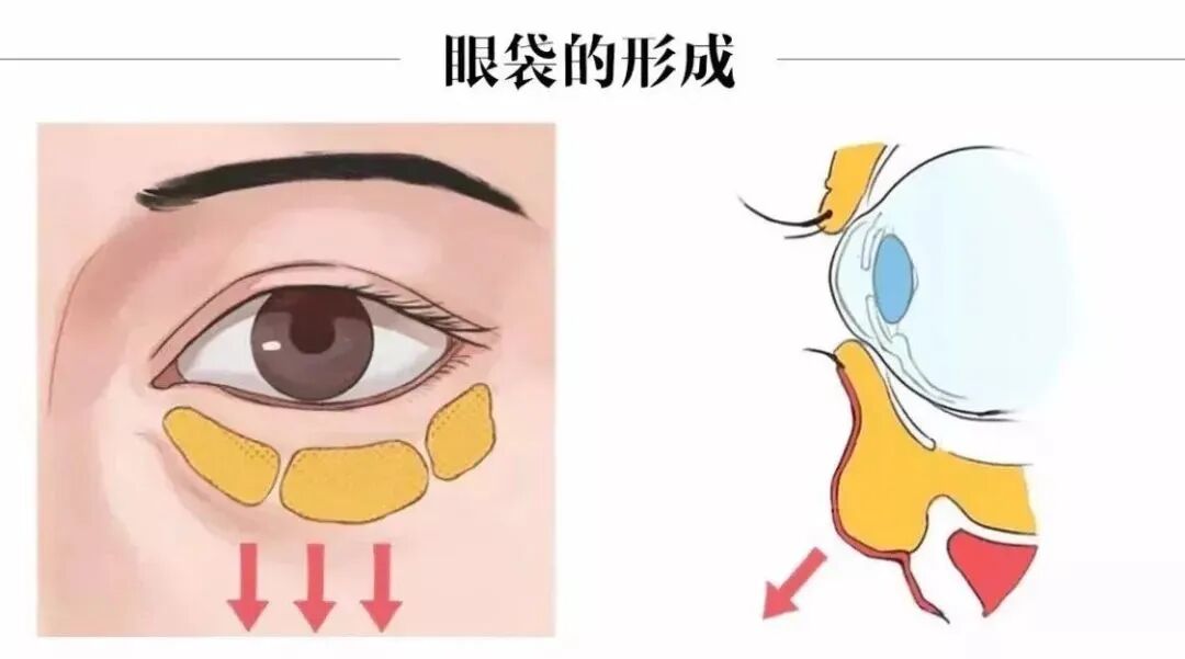 吸脂去眼袋的价格是多少?四大吸脂去眼袋的优势在这里插图 吸脂去眼袋的价格是多少?四大吸脂去眼袋的优势在这里插图